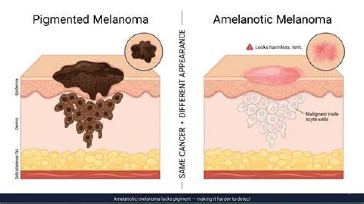 Can amelanotic melanoma appear overnight?