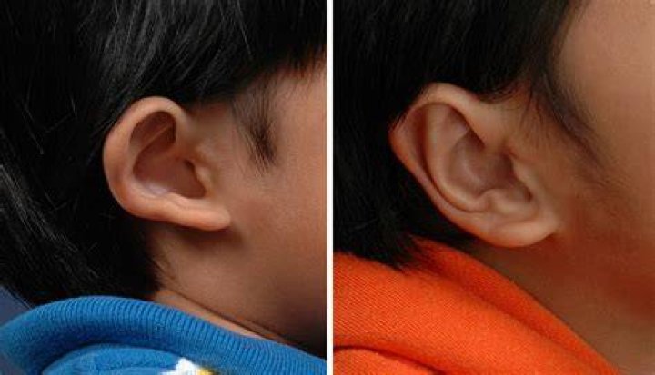 How do I stop my baby's ear from protruding?