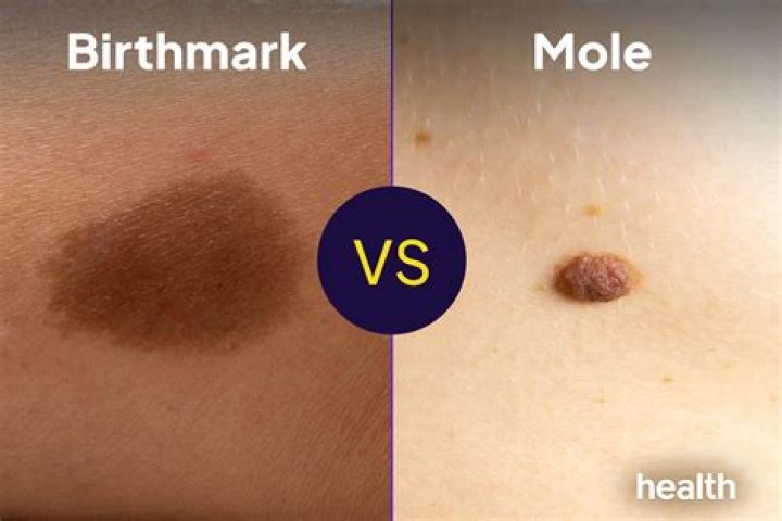 Is a birthmark a mole?