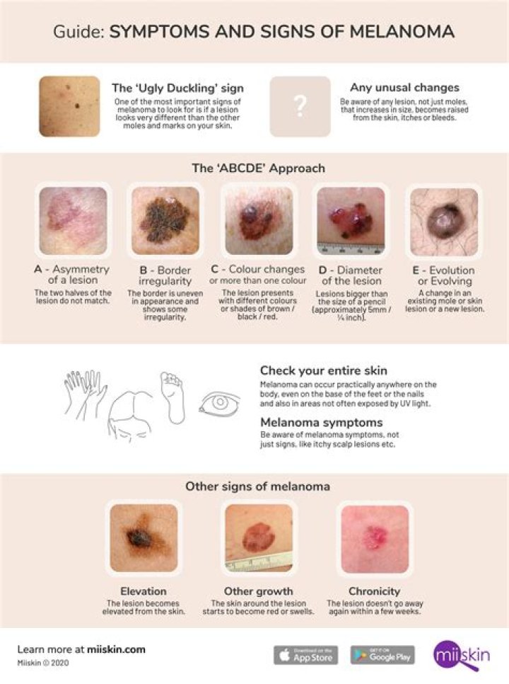 What are 2 symptoms of melanoma?