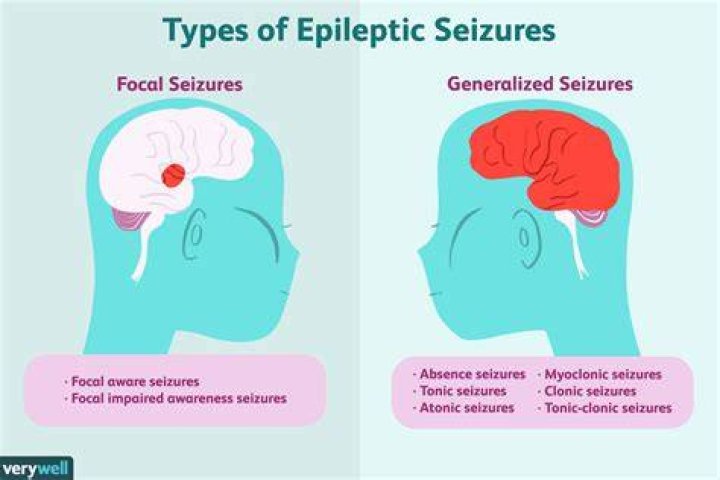 What is focal onset epilepsy?