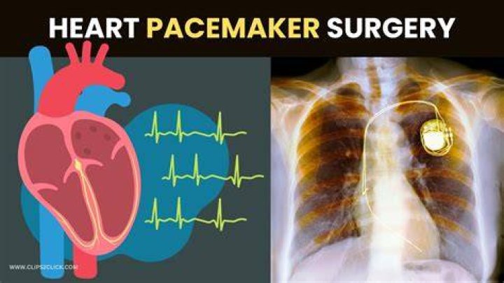 Why am I so tired after a pacemaker implant?